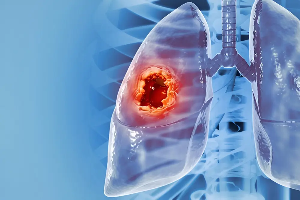 1162851-LUNG-CANCER