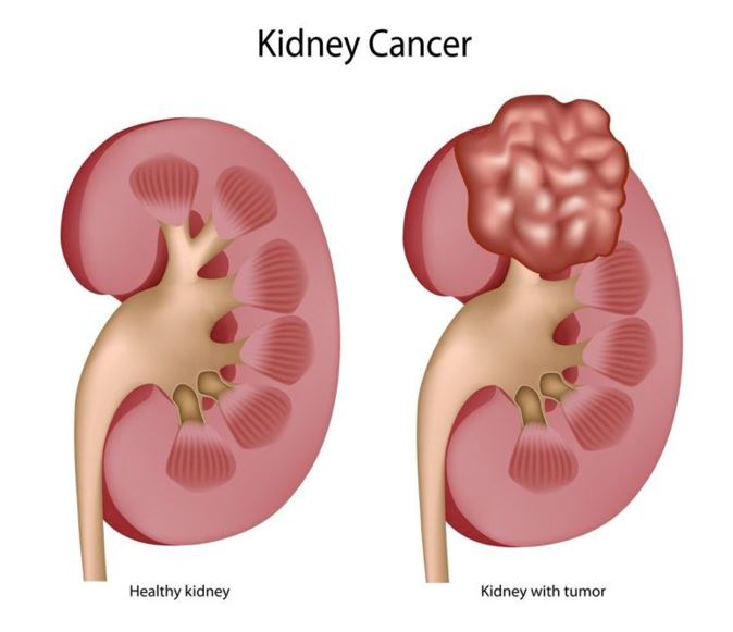 What is Kidney Cancer?