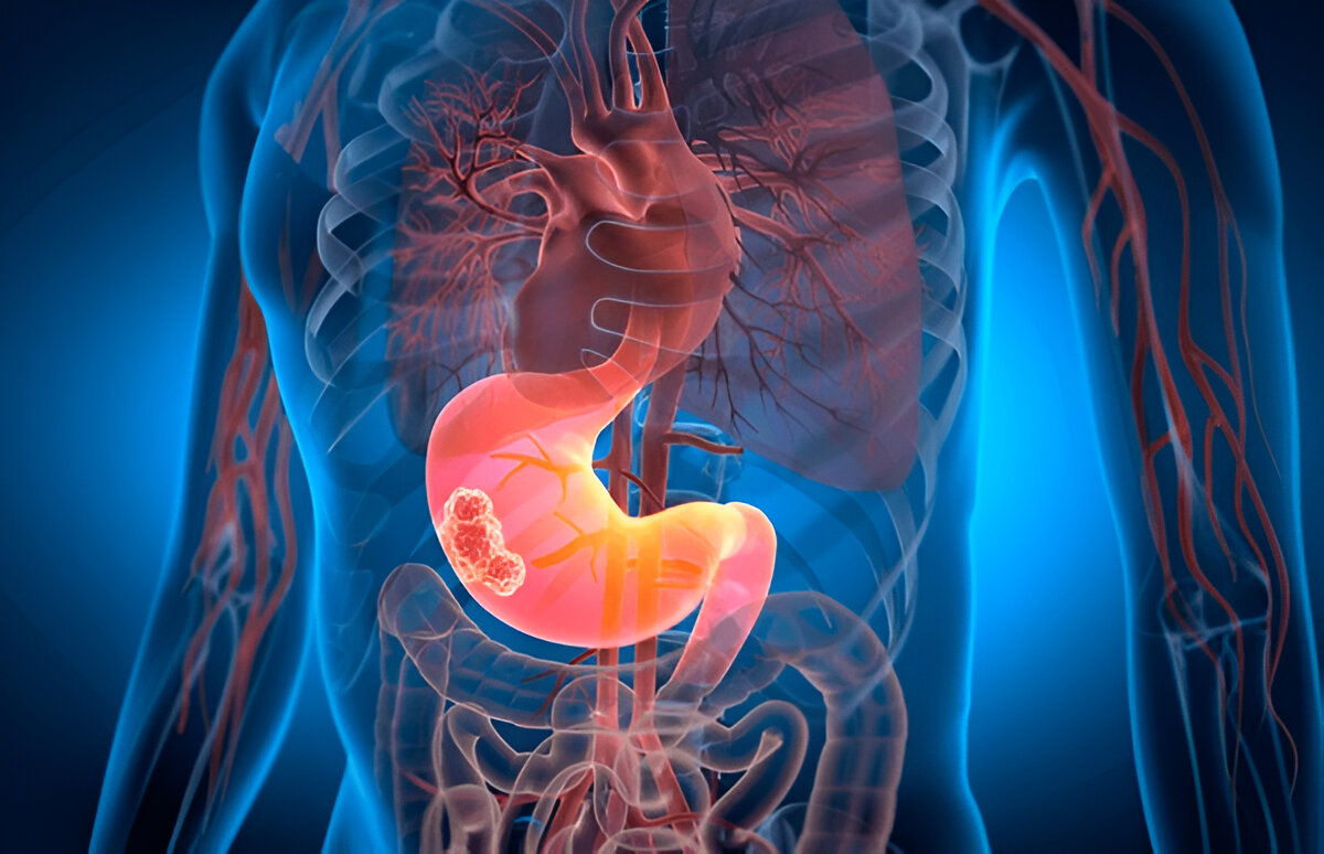 What is Stomach Cancer?