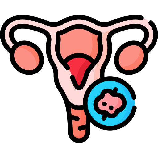 ovarian cancer